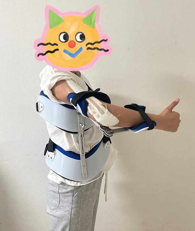 13歲少女患骨肉瘤面臨截肢，3D打印肱骨假體治療成功保肢